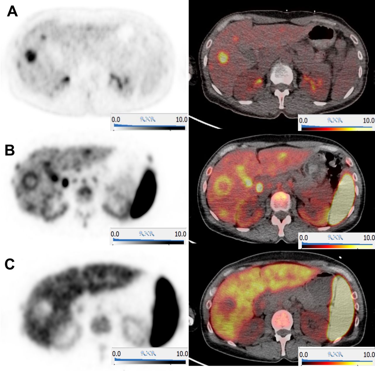 tumoriページ CD8 PET imaging with [89Zr]Zr-berdoxam-crefmirlimab in patients