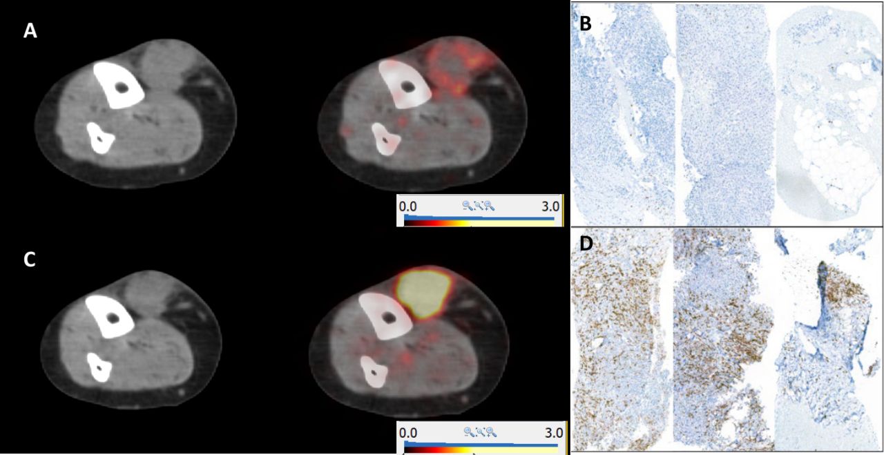 CD8 PET imaging with [89Zr]Zr-berdoxam-crefmirlimab in patients