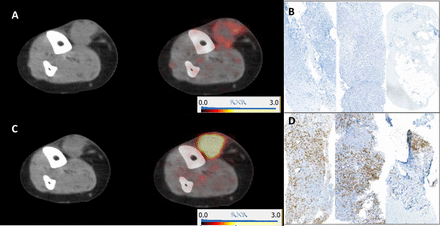 CD8 PET imaging with [89Zr]Zr-berdoxam-crefmirlimab in patients